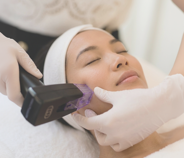 Microneedling radiofrequency handpiece being applied to a patient's cheek to treat acne scars