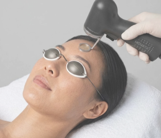 Patient in laser eye shields receiving a laser treatment for acne