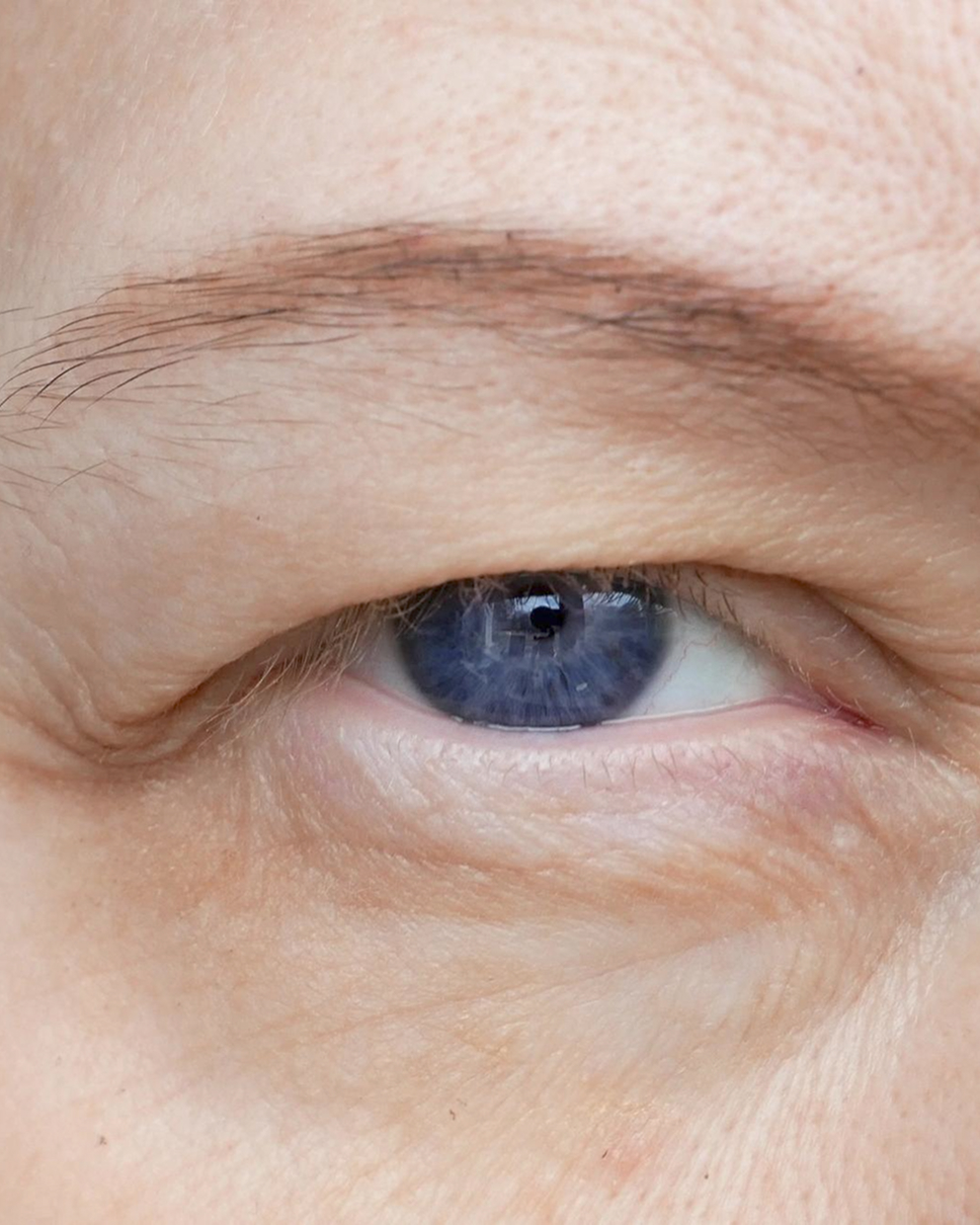 Droopy Eyelids