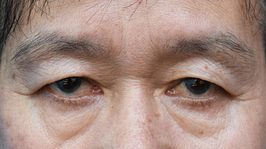 Droopy Eyelids