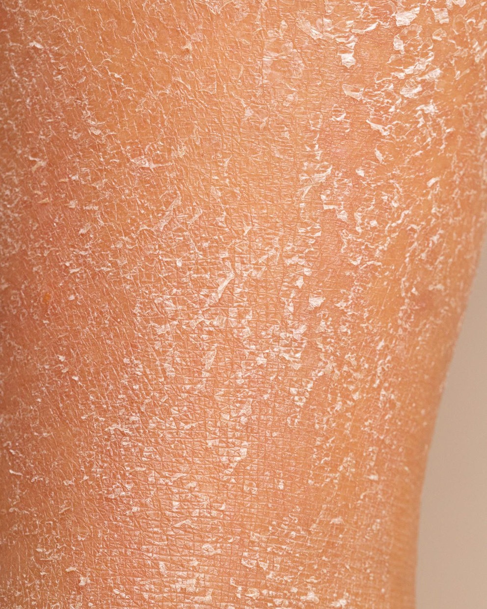 Dry and Dehydrated Skin