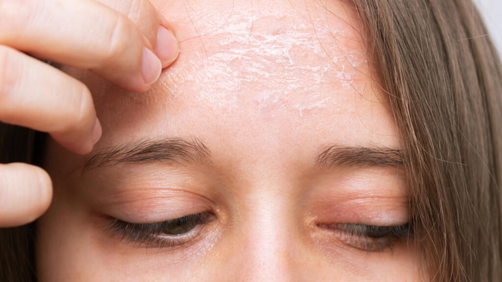 Dry and Dehydrated Skin