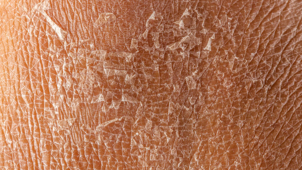 Dry and Dehydrated Skin