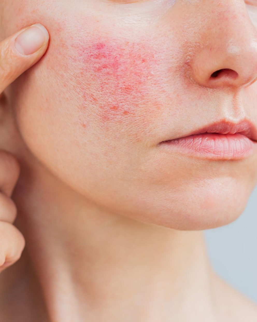 Woman's cheek held between her fingers, showing a patch of rosacea redness