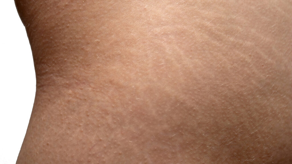 Stretch Mark