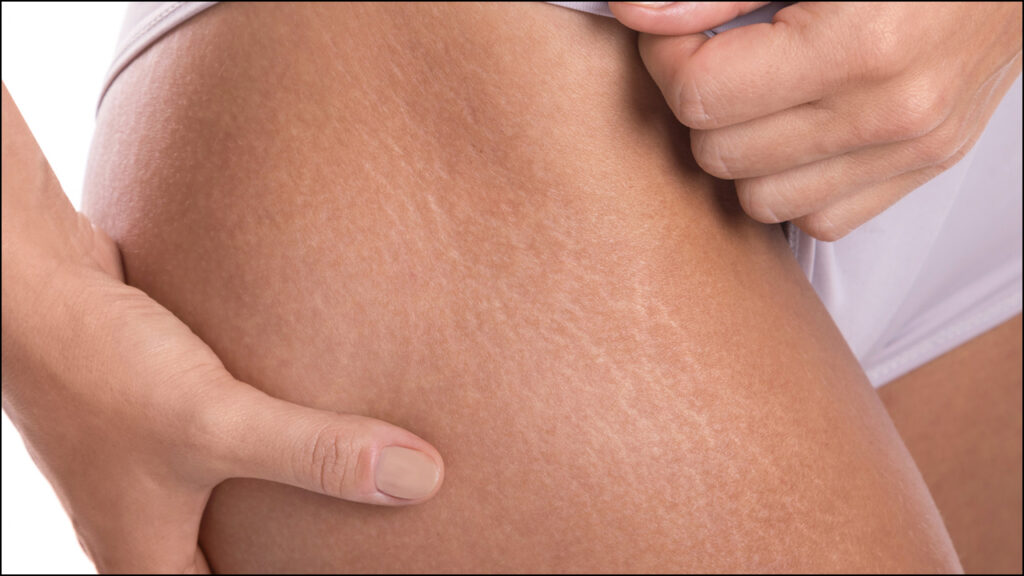Stretch Mark