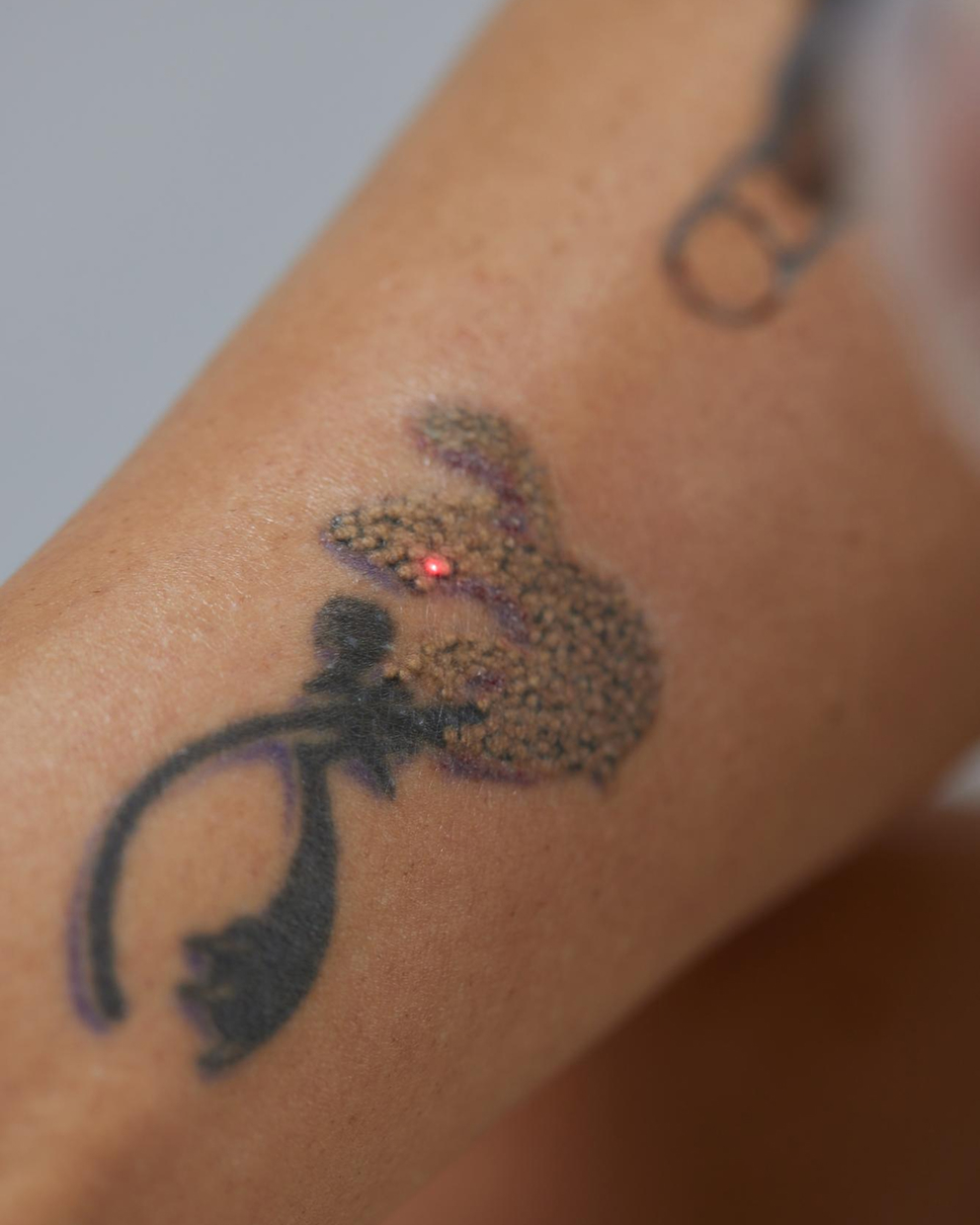 Tattoo Removal