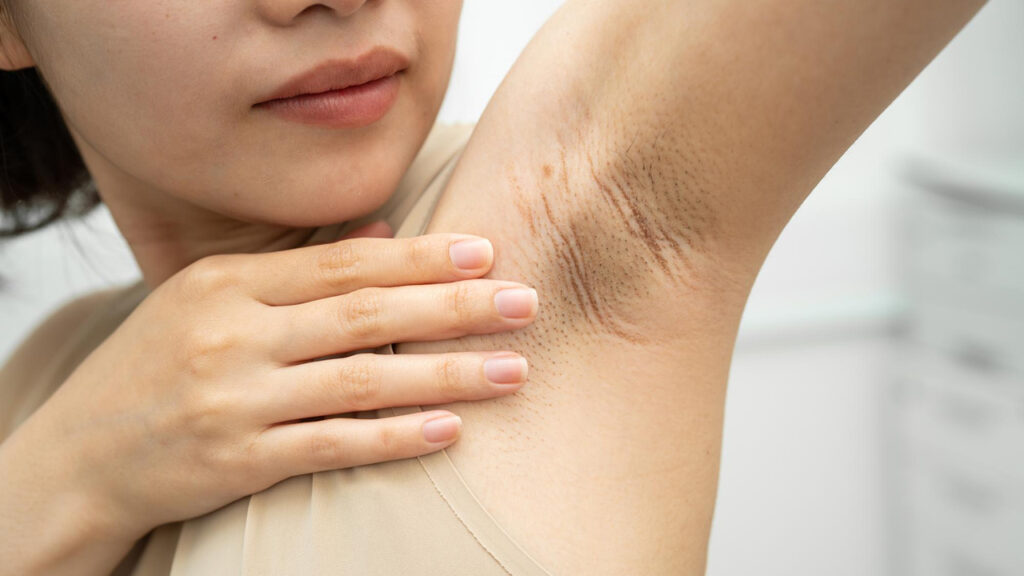 Underarm Pigmentation